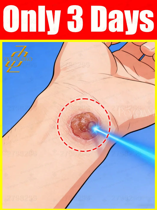 Improved 26th Generation Wart Repair Formula, Targeted Skin Care Treatment - Bond Well Supplies